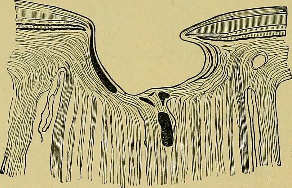 An illustration from Diseases of the eye / by Edward Nettleship ; with a supplement on examinations for color-blindness and acuity of vision and hearing, by William Thomson ; with 5 colored plates and 192 engravings., 1900, leaf 308