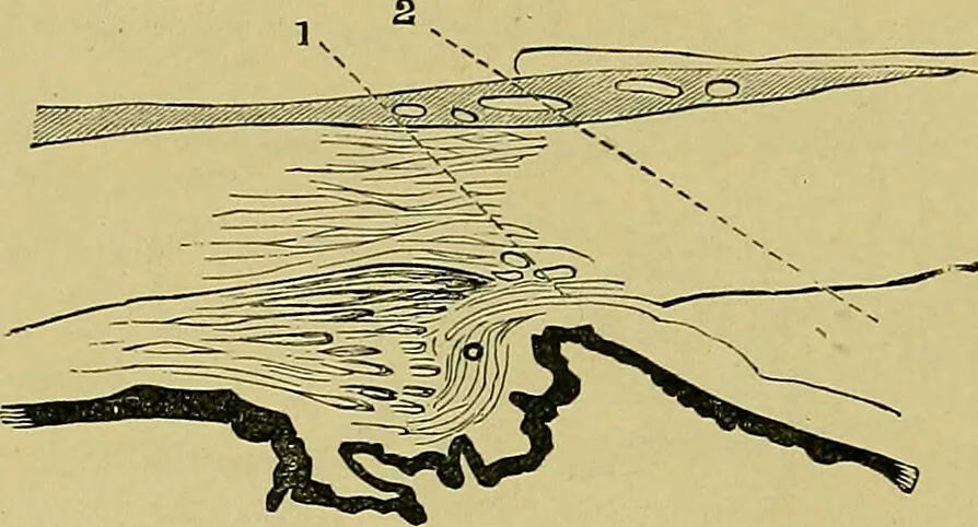 An illustration from Diseases of the eye / by Edward Nettleship ; with a supplement on examinations for color-blindness and acuity of vision and hearing, by William Thomson ; with 5 colored plates and 192 engravings., 1900, leaf 312