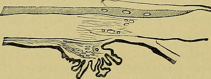An illustration from Diseases of the eye / by Edward Nettleship ; with a supplement on examinations for color-blindness and acuity of vision and hearing, by William Thomson ; with 5 colored plates and 192 engravings., 1900, leaf 312
