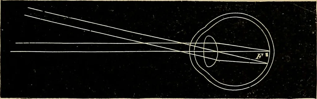 An illustration from Diseases of the eye / by Edward Nettleship ; with a supplement on examinations for color-blindness and acuity of vision and hearing, by William Thomson ; with 5 colored plates and 192 engravings., 1900, leaf 341