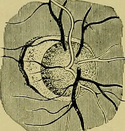 An illustration from Diseases of the eye / by Edward Nettleship ; with a supplement on examinations for color-blindness and acuity of vision and hearing, by William Thomson ; with 5 colored plates and 192 engravings., 1900, leaf 348