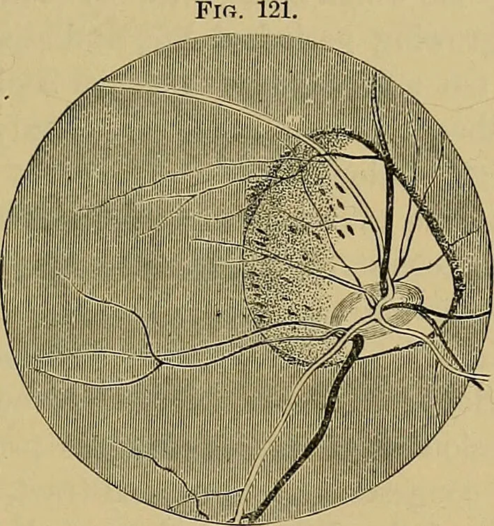 An illustration from Diseases of the eye / by Edward Nettleship ; with a supplement on examinations for color-blindness and acuity of vision and hearing, by William Thomson ; with 5 colored plates and 192 engravings., 1900, leaf 349
