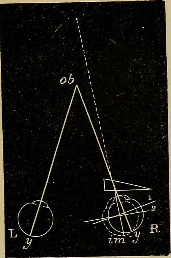 An illustration from Diseases of the eye / by Edward Nettleship ; with a supplement on examinations for color-blindness and acuity of vision and hearing, by William Thomson ; with 5 colored plates and 192 engravings., 1900, leaf 35