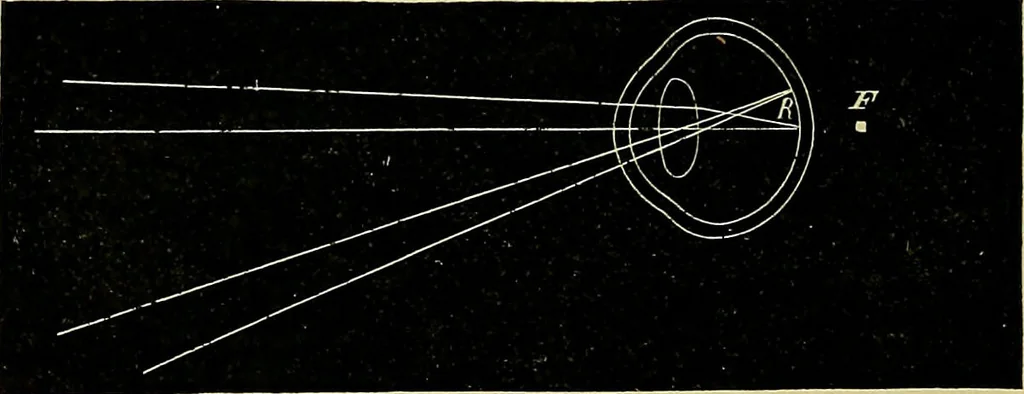 An illustration from Diseases of the eye / by Edward Nettleship ; with a supplement on examinations for color-blindness and acuity of vision and hearing, by William Thomson ; with 5 colored plates and 192 engravings., 1900, leaf 358