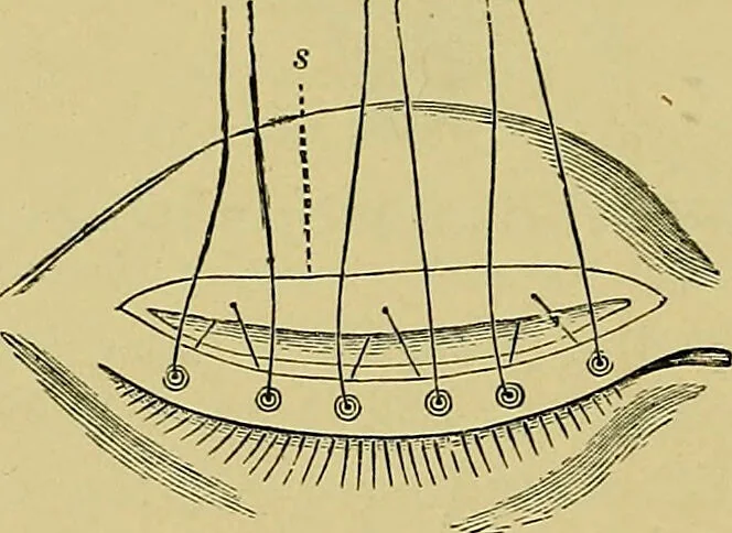 An illustration from Diseases of the eye / by Edward Nettleship ; with a supplement on examinations for color-blindness and acuity of vision and hearing, by William Thomson ; with 5 colored plates and 192 engravings., 1900, leaf 410