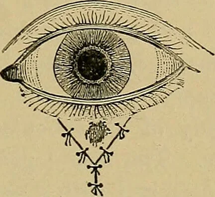 An illustration from Diseases of the eye / by Edward Nettleship ; with a supplement on examinations for color-blindness and acuity of vision and hearing, by William Thomson ; with 5 colored plates and 192 engravings., 1900, leaf 413