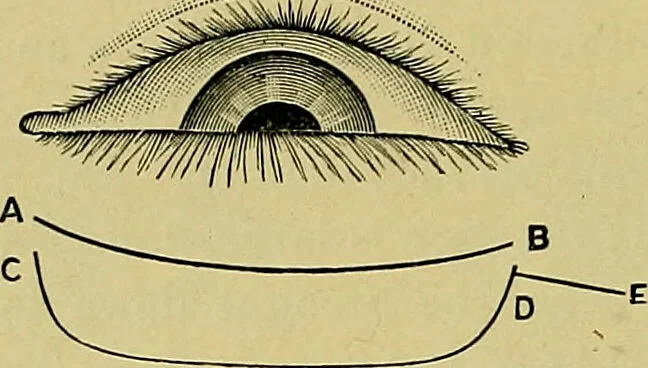 An illustration from Diseases of the eye / by Edward Nettleship ; with a supplement on examinations for color-blindness and acuity of vision and hearing, by William Thomson ; with 5 colored plates and 192 engravings., 1900, leaf 418