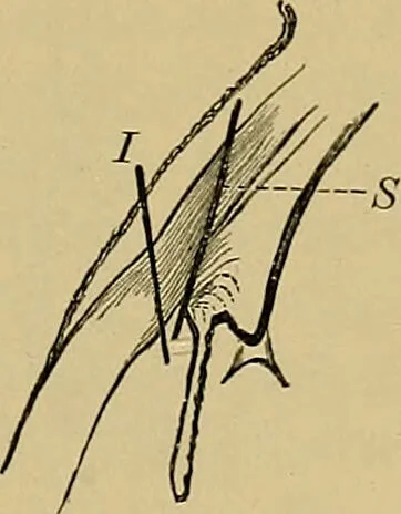 An illustration from Diseases of the eye / by Edward Nettleship ; with a supplement on examinations for color-blindness and acuity of vision and hearing, by William Thomson ; with 5 colored plates and 192 engravings., 1900, leaf 443