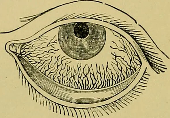 An illustration from Diseases of the eye / by Edward Nettleship ; with a supplement on examinations for color-blindness and acuity of vision and hearing, by William Thomson ; with 5 colored plates and 192 engravings., 1900, leaf 46