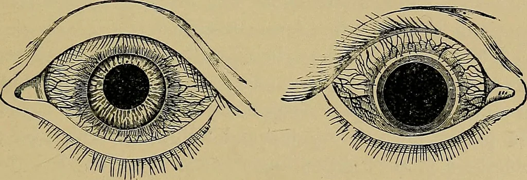 An illustration from Diseases of the eye / by Edward Nettleship ; with a supplement on examinations for color-blindness and acuity of vision and hearing, by William Thomson ; with 5 colored plates and 192 engravings., 1900, leaf 47