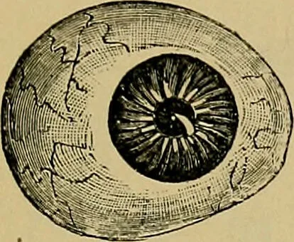 An illustration from Diseases of the eye / by Edward Nettleship ; with a supplement on examinations for color-blindness and acuity of vision and hearing, by William Thomson ; with 5 colored plates and 192 engravings., 1900, leaf 545