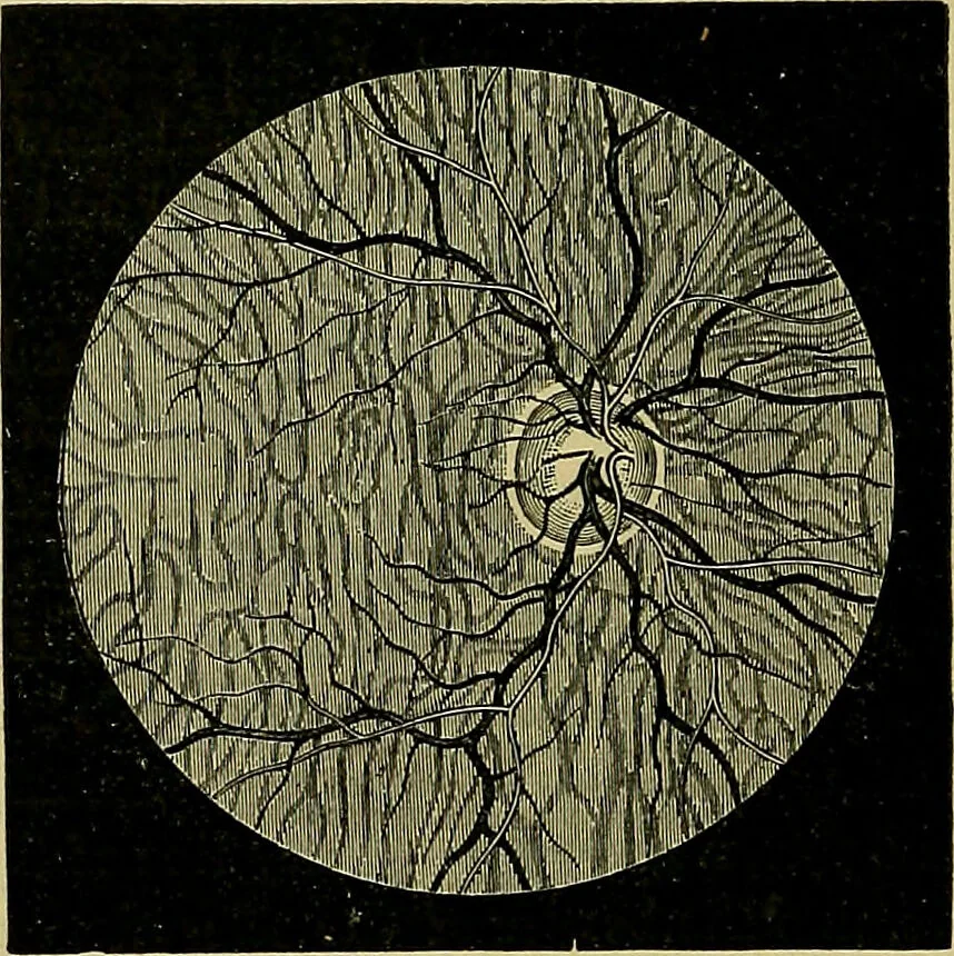 An illustration from Diseases of the eye / by Edward Nettleship ; with a supplement on examinations for color-blindness and acuity of vision and hearing, by William Thomson ; with 5 colored plates and 192 engravings., 1900, leaf 72