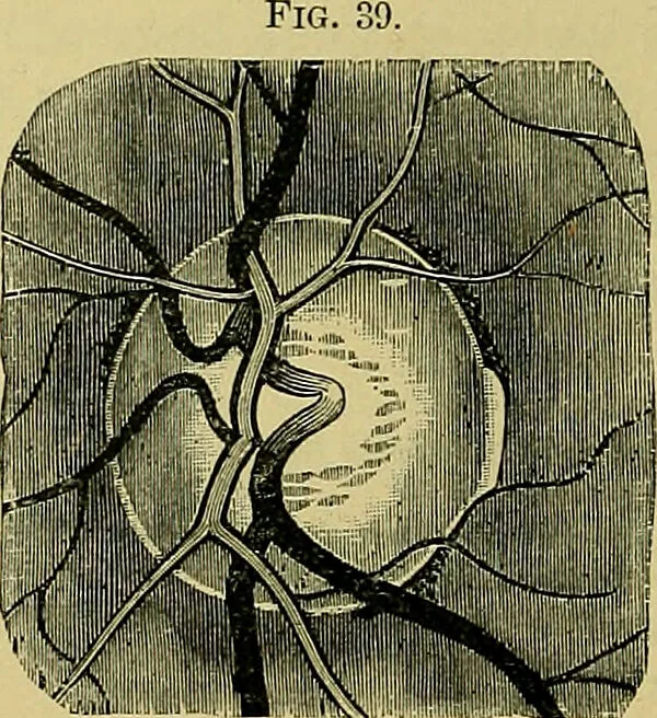 An illustration from Diseases of the eye / by Edward Nettleship ; with a supplement on examinations for color-blindness and acuity of vision and hearing, by William Thomson ; with 5 colored plates and 192 engravings., 1900, leaf 80