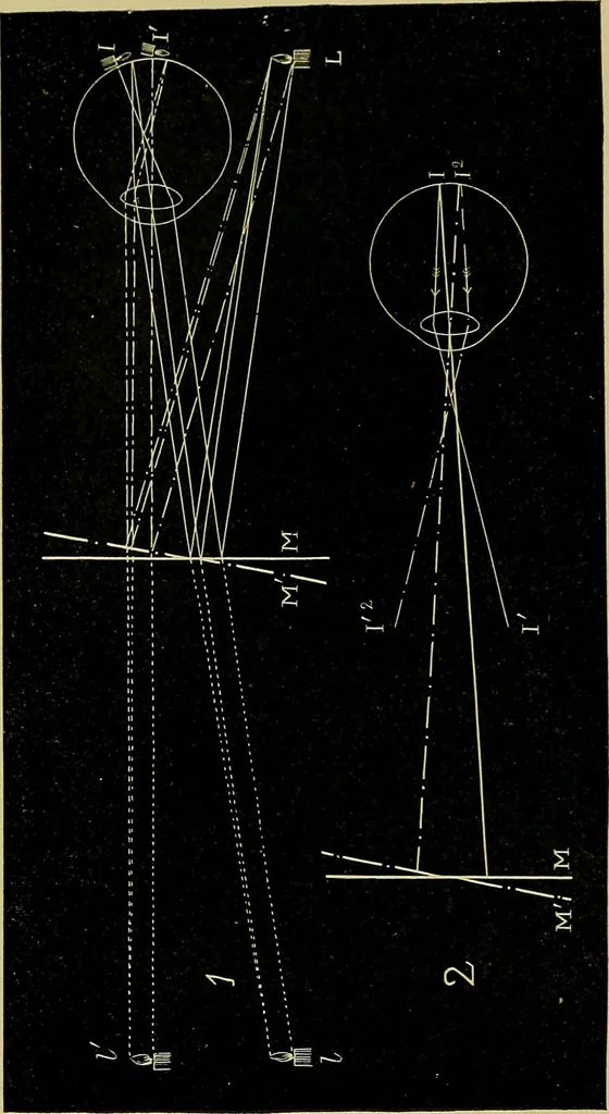 An illustration from Diseases of the eye / by Edward Nettleship ; with a supplement on examinations for color-blindness and acuity of vision and hearing, by William Thomson ; with 5 colored plates and 192 engravings., 1900, leaf 86