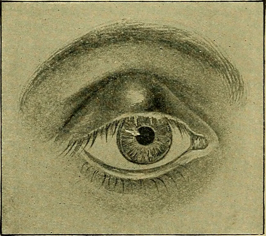 An illustration from Diseases of the eye / by Edward Nettleship ; with a supplement on examinations for color-blindness and acuity of vision and hearing, by William Thomson ; with 5 colored plates and 192 engravings., 1900, leaf 94