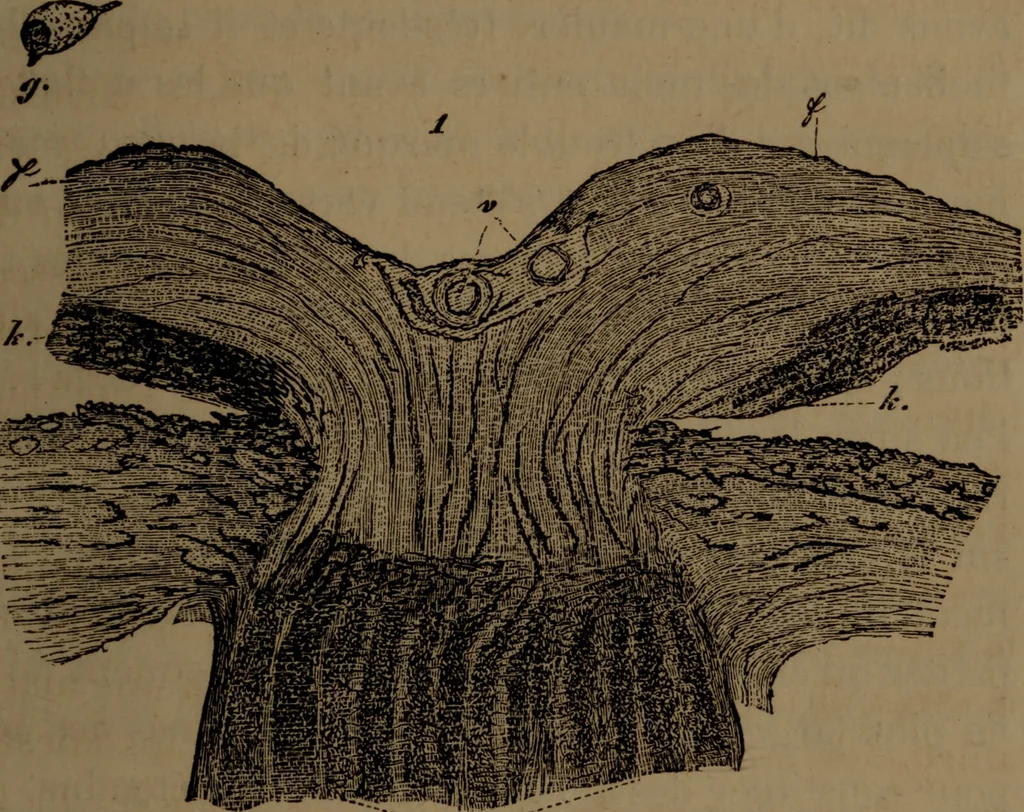 An illustration from Des altérations de l'oeil dans l'albuminurie et le diabète / par Mohammed Off ; avec planches en chromolithographie., 1870, leaf 77