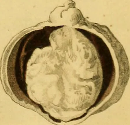 An illustration from A treatise on some practical points relating to the diseases of the eye / by the late John Cunningham Saunders ... ; to which is added, a short account of the author's life, and his method of curing the congenital cataract, by his friend and colleague J. R. Farre ; the whole illustrated by coloured engravings., 1811, leaf 251
