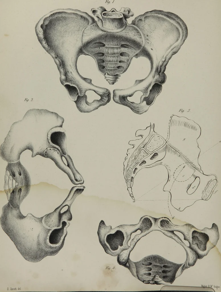 An illustration from Obstetric tables : comprising graphic illustrations, with descriptions and practical remarks : exhibiting on dissected plates many important subjects in midwifery / by G. Spratt., 1848, leaf 66
