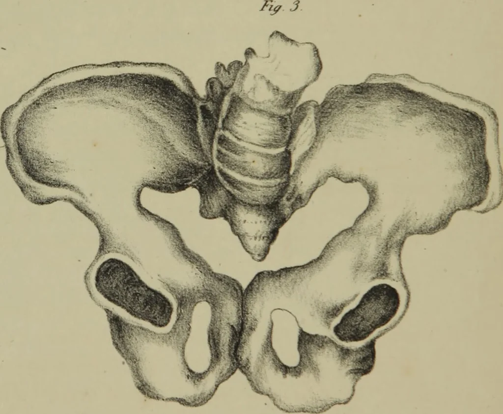 An illustration from Obstetric tables : comprising graphic illustrations, with descriptions and practical remarks : exhibiting on dissected plates many important subjects in midwifery / by G. Spratt., 1848, leaf 78