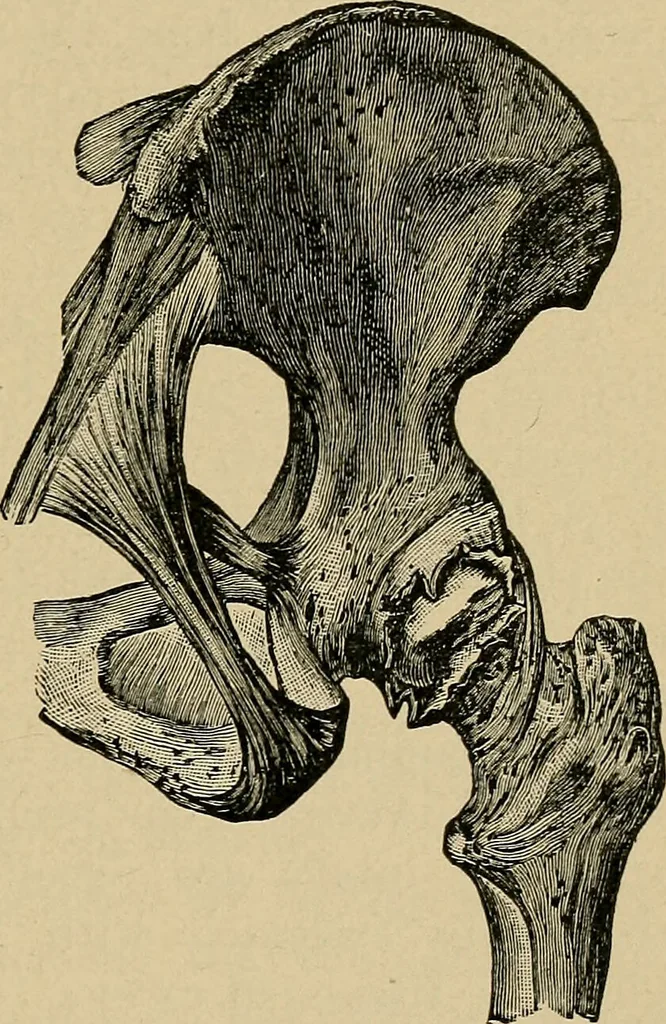 An illustration from Atlas and epitome of traumatic fractures and dislocations / by H. Helferich ; auth. tr. from the German, ed. by Joseph C. Bloodgood., 1902, leaf 101