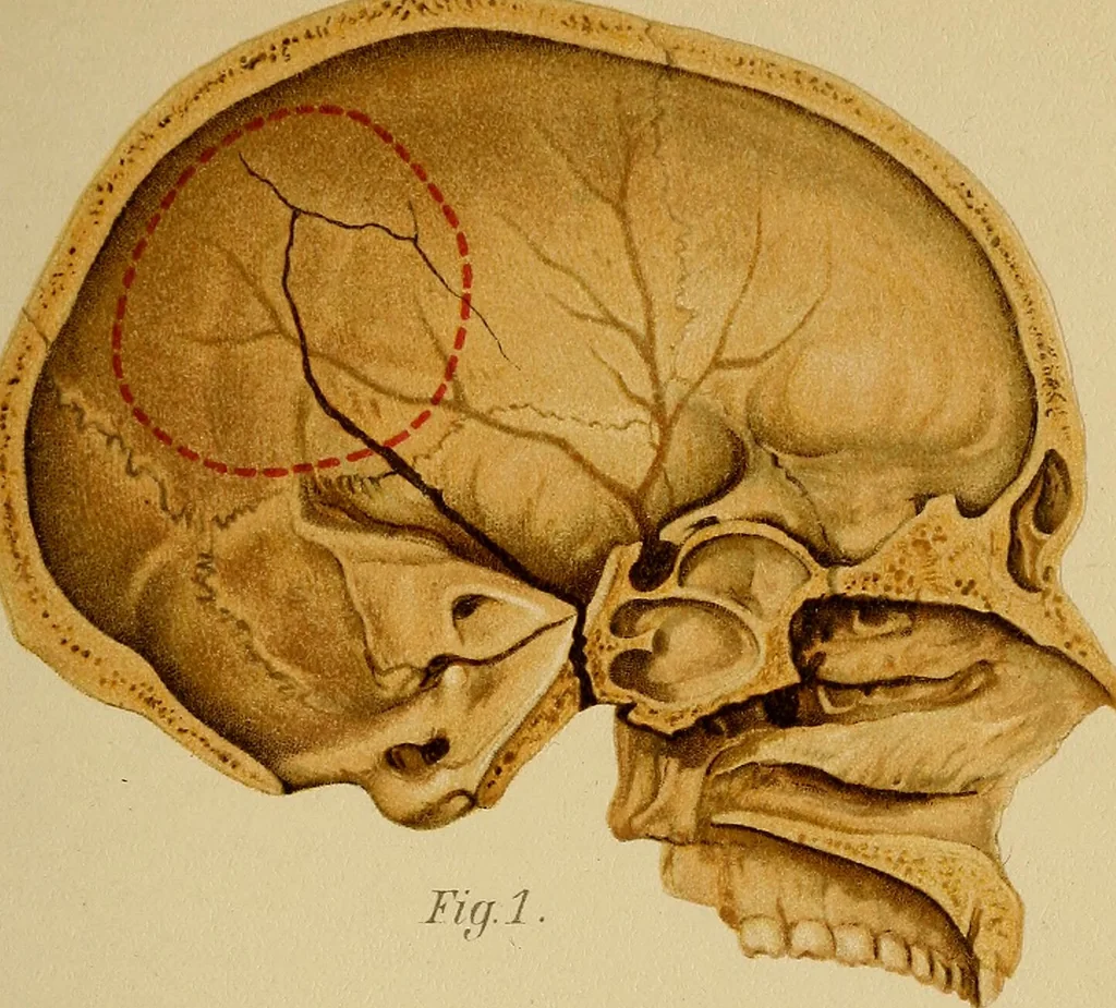 An illustration from Atlas and epitome of traumatic fractures and dislocations / by H. Helferich ; auth. tr. from the German, ed. by Joseph C. Bloodgood., 1902, leaf 135