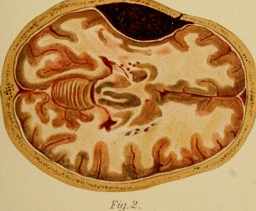 An illustration from Atlas and epitome of traumatic fractures and dislocations / by H. Helferich ; auth. tr. from the German, ed. by Joseph C. Bloodgood., 1902, leaf 135