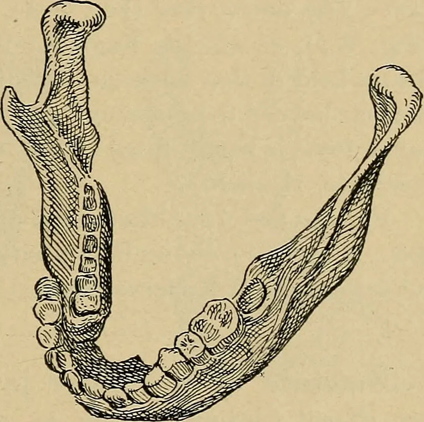 An illustration from Atlas and epitome of traumatic fractures and dislocations / by H. Helferich ; auth. tr. from the German, ed. by Joseph C. Bloodgood., 1902, leaf 139