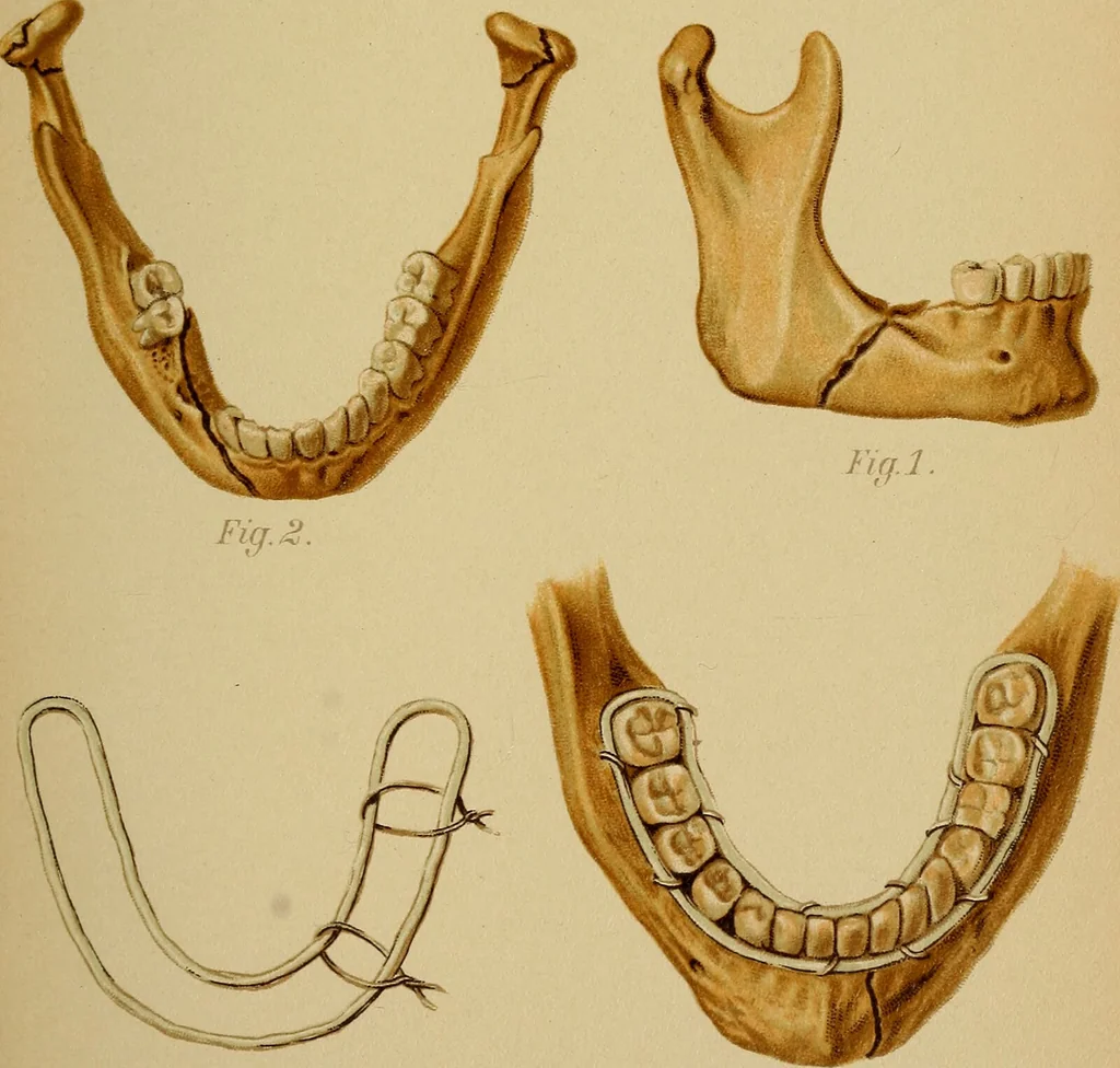 An illustration from Atlas and epitome of traumatic fractures and dislocations / by H. Helferich ; auth. tr. from the German, ed. by Joseph C. Bloodgood., 1902, leaf 141
