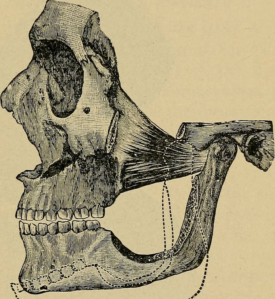 An illustration from Atlas and epitome of traumatic fractures and dislocations / by H. Helferich ; auth. tr. from the German, ed. by Joseph C. Bloodgood., 1902, leaf 147