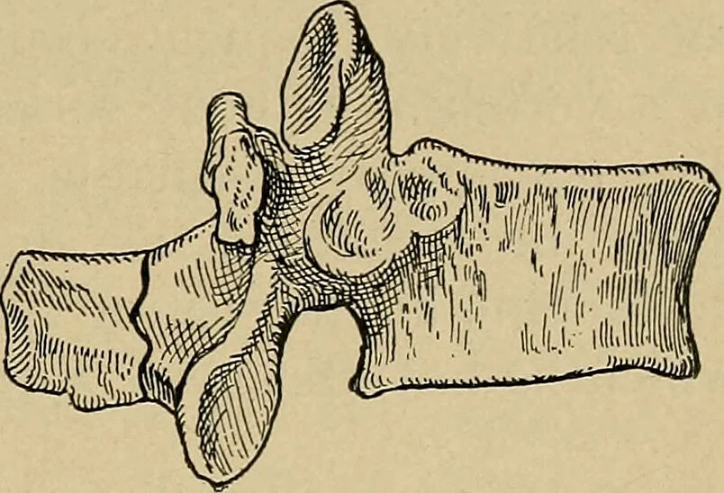 An illustration from Atlas and epitome of traumatic fractures and dislocations / by H. Helferich ; auth. tr. from the German, ed. by Joseph C. Bloodgood., 1902, leaf 163