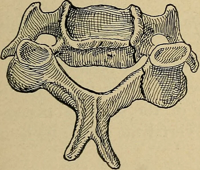 An illustration from Atlas and epitome of traumatic fractures and dislocations / by H. Helferich ; auth. tr. from the German, ed. by Joseph C. Bloodgood., 1902, leaf 163