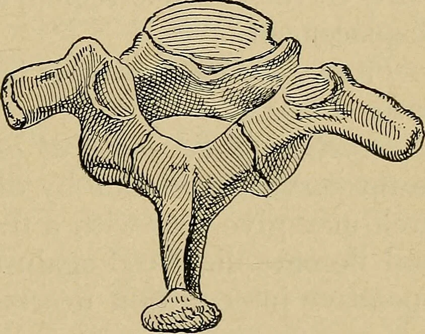 An illustration from Atlas and epitome of traumatic fractures and dislocations / by H. Helferich ; auth. tr. from the German, ed. by Joseph C. Bloodgood., 1902, leaf 163