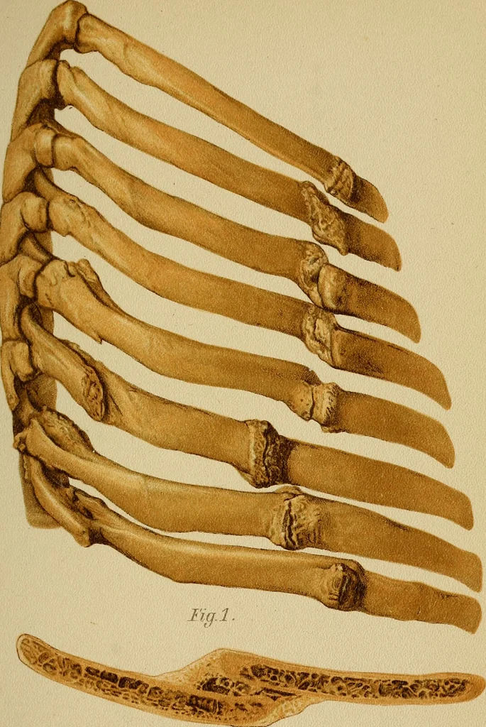 An illustration from Atlas and epitome of traumatic fractures and dislocations / by H. Helferich ; auth. tr. from the German, ed. by Joseph C. Bloodgood., 1902, leaf 171