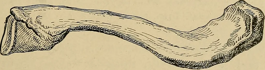 An illustration from Atlas and epitome of traumatic fractures and dislocations / by H. Helferich ; auth. tr. from the German, ed. by Joseph C. Bloodgood., 1902, leaf 187