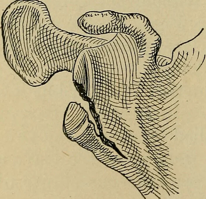 An illustration from Atlas and epitome of traumatic fractures and dislocations / by H. Helferich ; auth. tr. from the German, ed. by Joseph C. Bloodgood., 1902, leaf 196