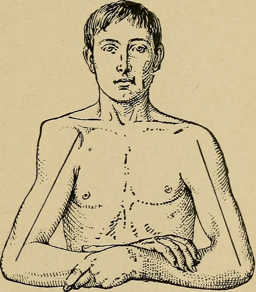 An illustration from Atlas and epitome of traumatic fractures and dislocations / by H. Helferich ; auth. tr. from the German, ed. by Joseph C. Bloodgood., 1902, leaf 207
