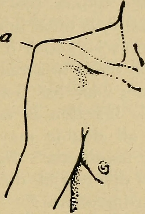 An illustration from Atlas and epitome of traumatic fractures and dislocations / by H. Helferich ; auth. tr. from the German, ed. by Joseph C. Bloodgood., 1902, leaf 211
