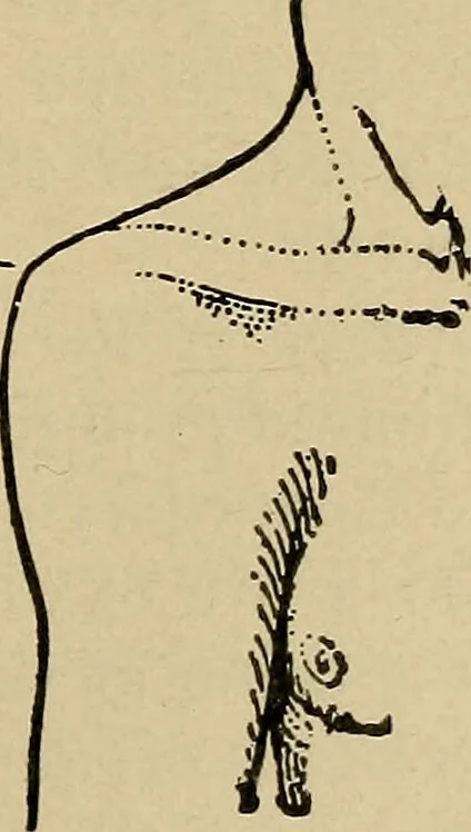 An illustration from Atlas and epitome of traumatic fractures and dislocations / by H. Helferich ; auth. tr. from the German, ed. by Joseph C. Bloodgood., 1902, leaf 211