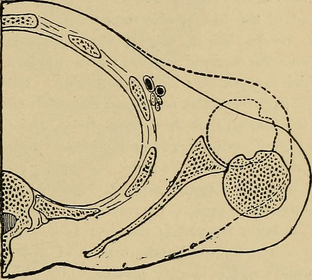 An illustration from Atlas and epitome of traumatic fractures and dislocations / by H. Helferich ; auth. tr. from the German, ed. by Joseph C. Bloodgood., 1902, leaf 223
