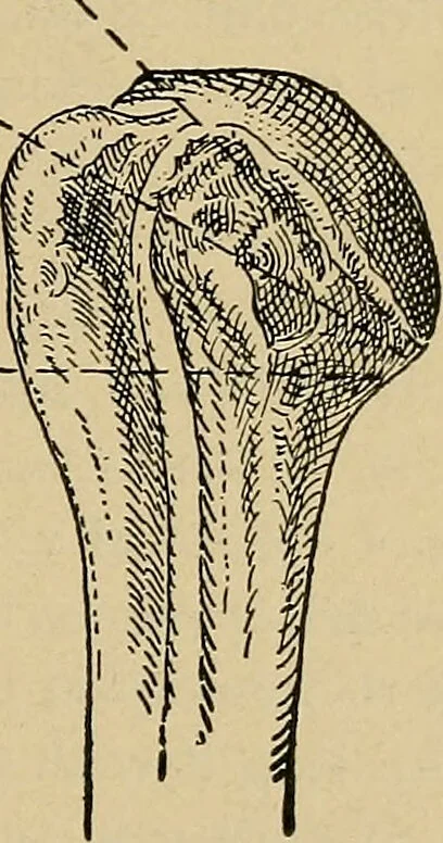 An illustration from Atlas and epitome of traumatic fractures and dislocations / by H. Helferich ; auth. tr. from the German, ed. by Joseph C. Bloodgood., 1902, leaf 227