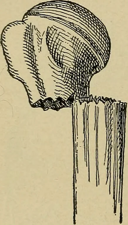 An illustration from Atlas and epitome of traumatic fractures and dislocations / by H. Helferich ; auth. tr. from the German, ed. by Joseph C. Bloodgood., 1902, leaf 232