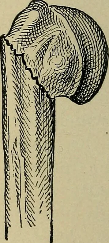 An illustration from Atlas and epitome of traumatic fractures and dislocations / by H. Helferich ; auth. tr. from the German, ed. by Joseph C. Bloodgood., 1902, leaf 232