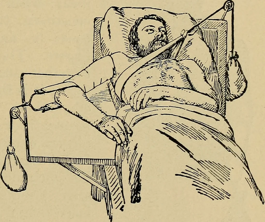 An illustration from Atlas and epitome of traumatic fractures and dislocations / by H. Helferich ; auth. tr. from the German, ed. by Joseph C. Bloodgood., 1902, leaf 235