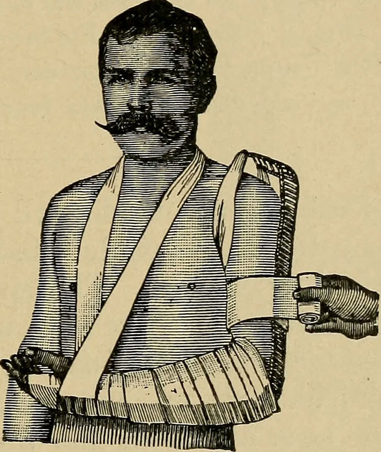 An illustration from Atlas and epitome of traumatic fractures and dislocations / by H. Helferich ; auth. tr. from the German, ed. by Joseph C. Bloodgood., 1902, leaf 243