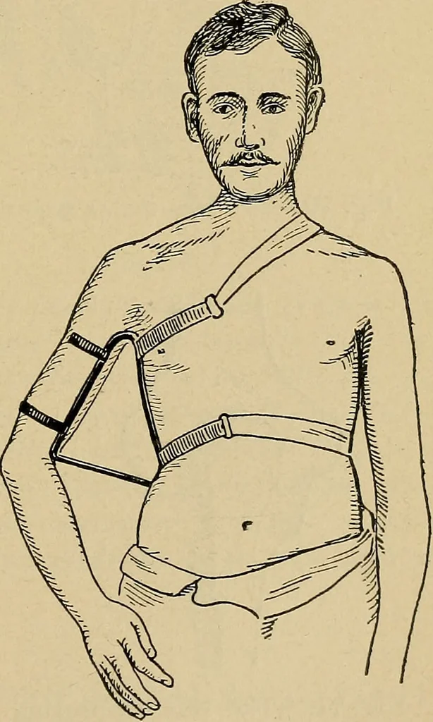 An illustration from Atlas and epitome of traumatic fractures and dislocations / by H. Helferich ; auth. tr. from the German, ed. by Joseph C. Bloodgood., 1902, leaf 251