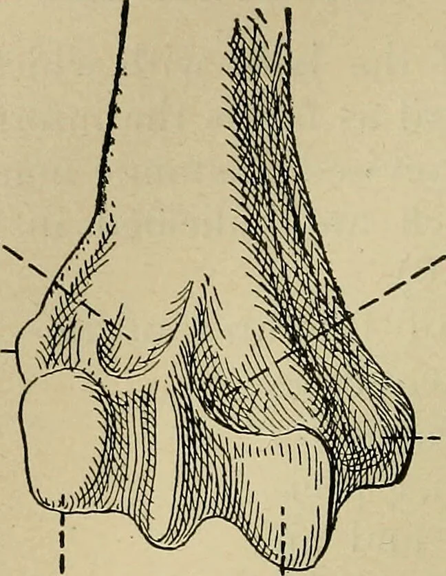 An illustration from Atlas and epitome of traumatic fractures and dislocations / by H. Helferich ; auth. tr. from the German, ed. by Joseph C. Bloodgood., 1902, leaf 252