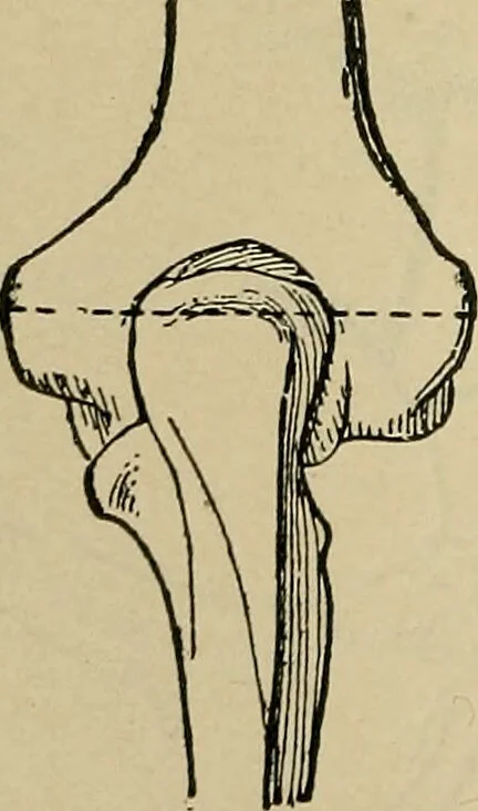 An illustration from Atlas and epitome of traumatic fractures and dislocations / by H. Helferich ; auth. tr. from the German, ed. by Joseph C. Bloodgood., 1902, leaf 252