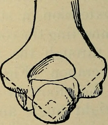 An illustration from Atlas and epitome of traumatic fractures and dislocations / by H. Helferich ; auth. tr. from the German, ed. by Joseph C. Bloodgood., 1902, leaf 252
