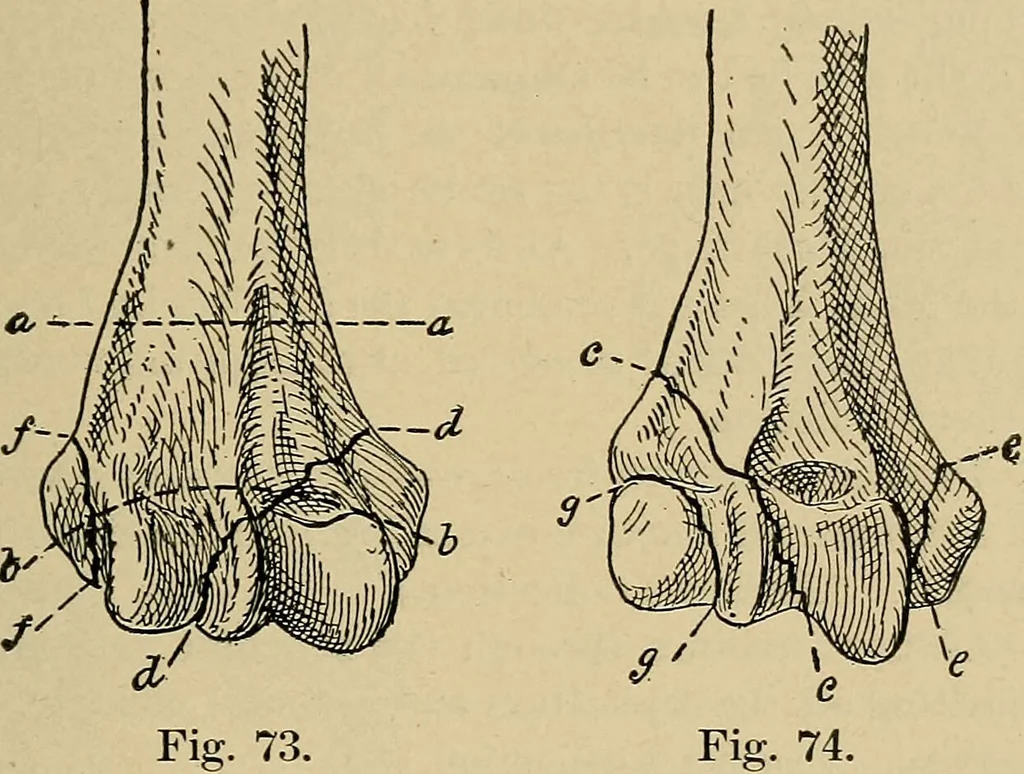 An illustration from Atlas and epitome of traumatic fractures and dislocations / by H. Helferich ; auth. tr. from the German, ed. by Joseph C. Bloodgood., 1902, leaf 253