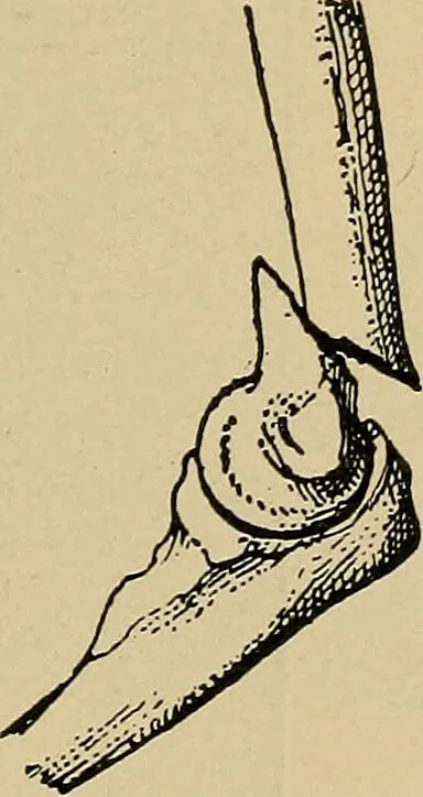 An illustration from Atlas and epitome of traumatic fractures and dislocations / by H. Helferich ; auth. tr. from the German, ed. by Joseph C. Bloodgood., 1902, leaf 257